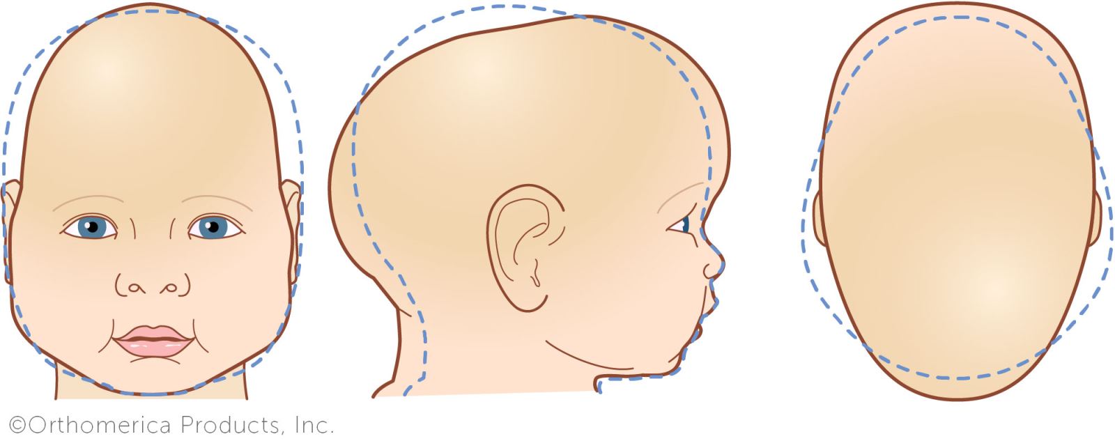 kraniosinostoz nedir cranial tedavi merkezi