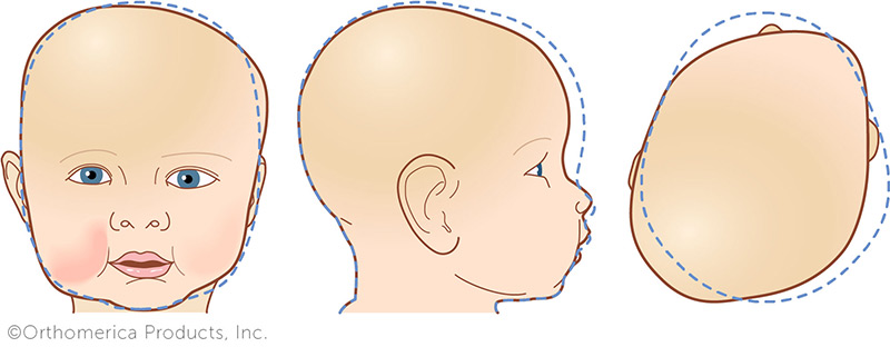 deformasyonel plagiosefali cranial tedavi merkezi